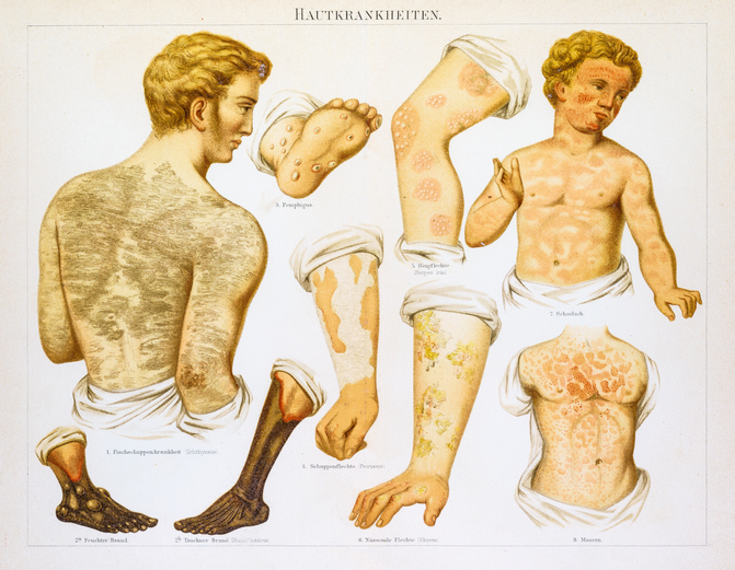 Old medical images of people with measles. This shows different body parts with red rashes